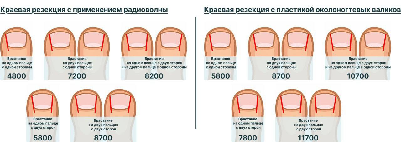 Удаление вросшего ногтя